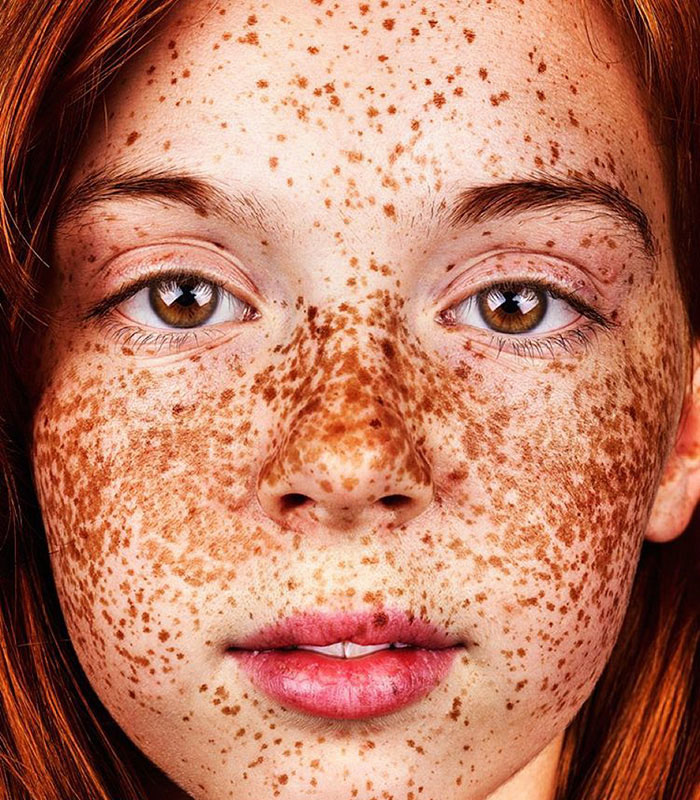 Freckles everywhere