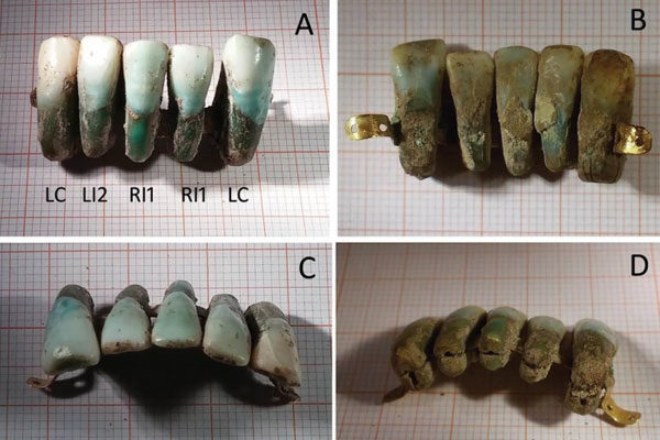 Very medieval dental prostheses